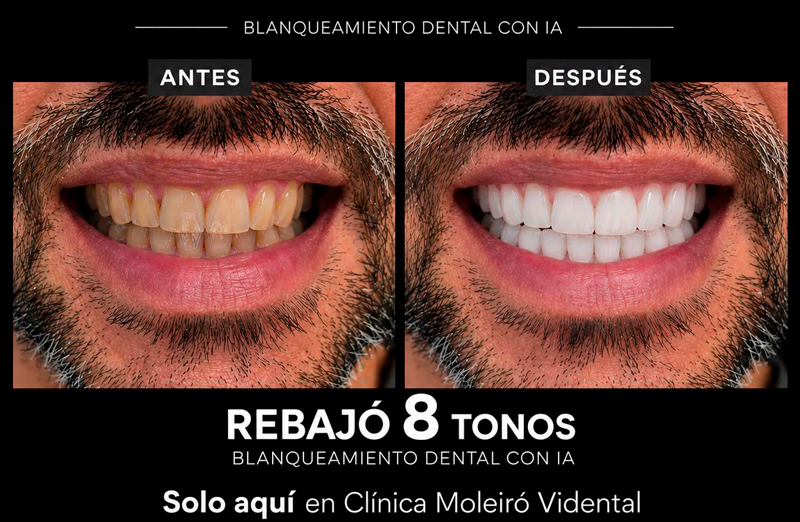 Caso 2 - Blanqueamiento dental