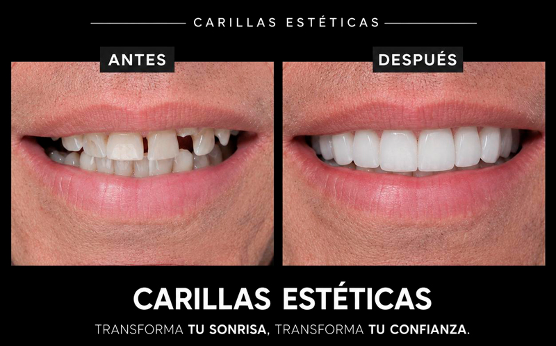 Caso 1 - Carillas estéticas
